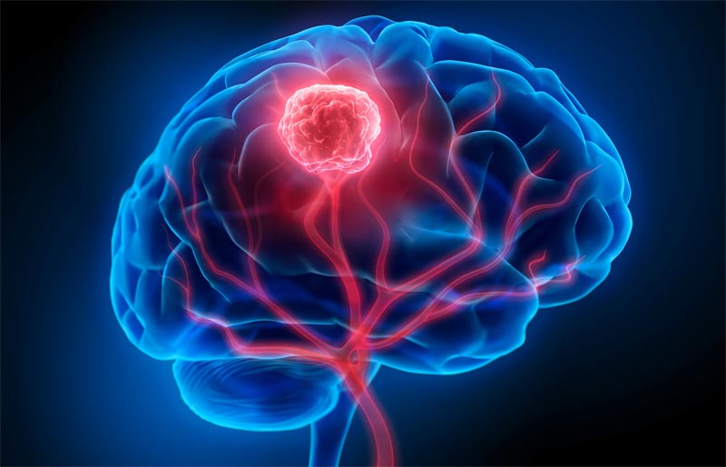 تشخیص آفات و تومورهای مغزی از طریق معاینات چشم