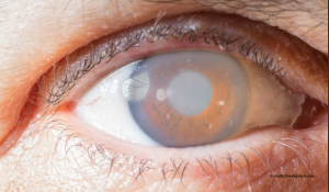 آب سیاه چشم (Glaucoma)