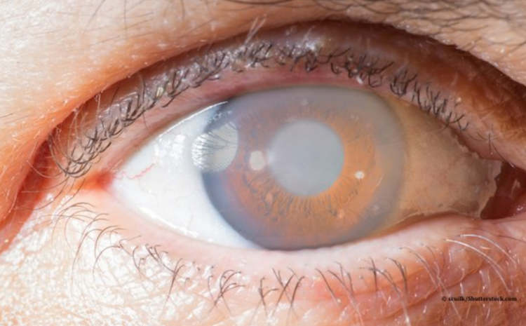  آب سیاه چشم (Glaucoma)