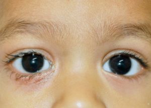 انسداد مجرای اشکی در کودکان – NLDO